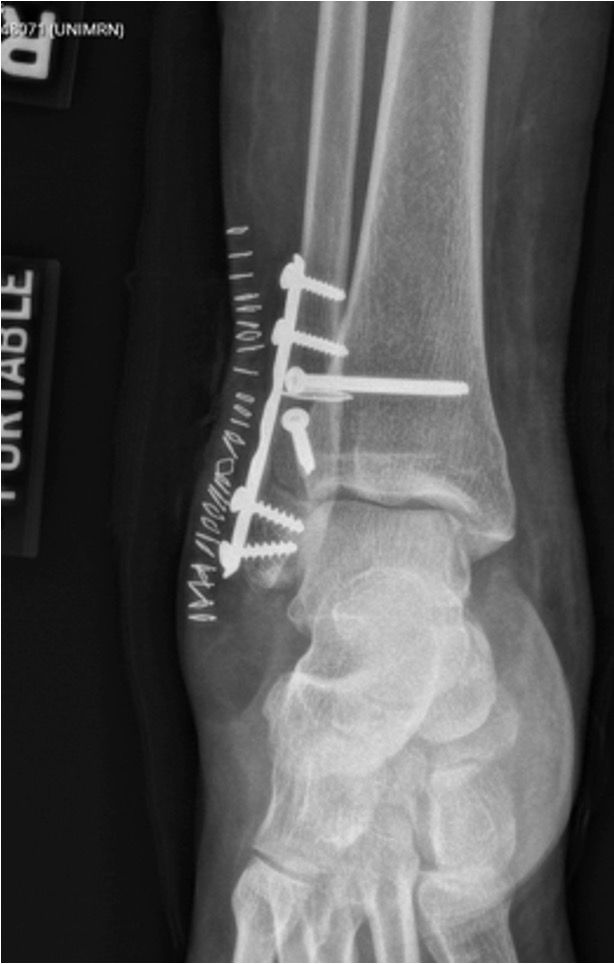 Ankle Fracture Post Open Reduction Internal Fixation