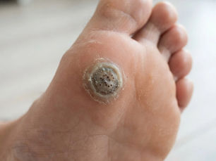 Plantar Wart