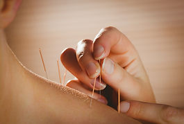 Precise dry-needling treatment by Clarke Flynn, aimed at reducing pain and promoting healing, at ProSport Ottawa Massage.