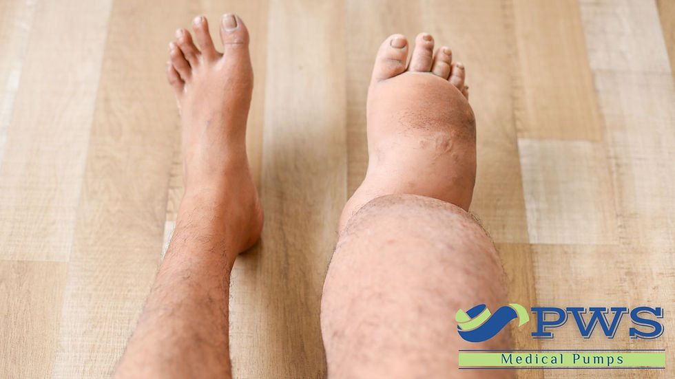 A lymphedema flare-up may cause noticeable changes in swelling, heaviness, tightness, or discomfort. Understanding what is normal for your body can help you recognize when symptoms change.