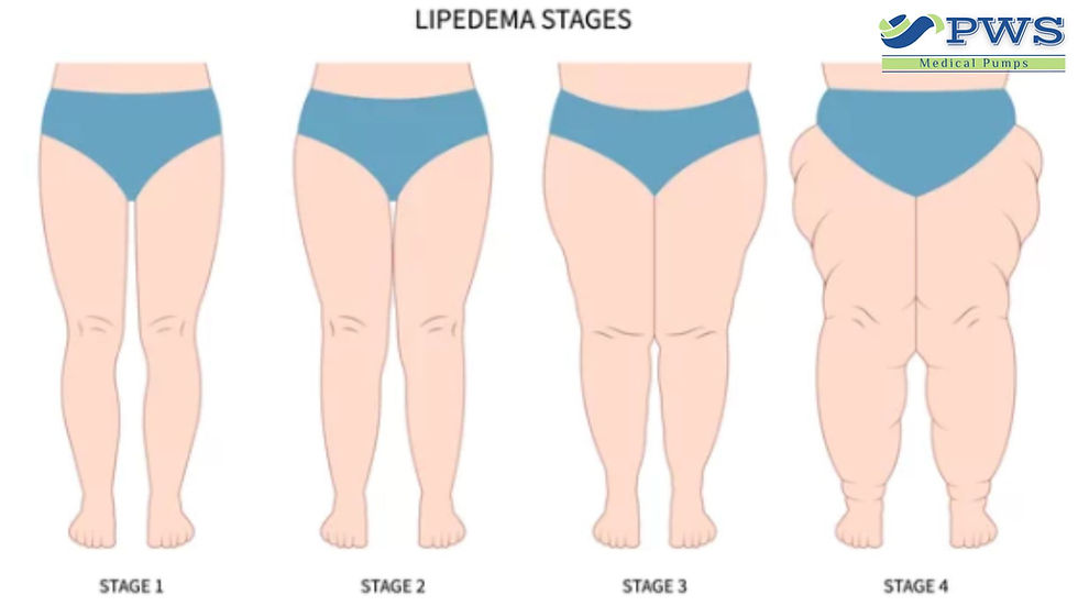 Illustration comparing stages 1 through 4 of lipedema, from mild symmetrical leg enlargement to more advanced tissue folds and swelling, with the PWS Medical Pumps logo.