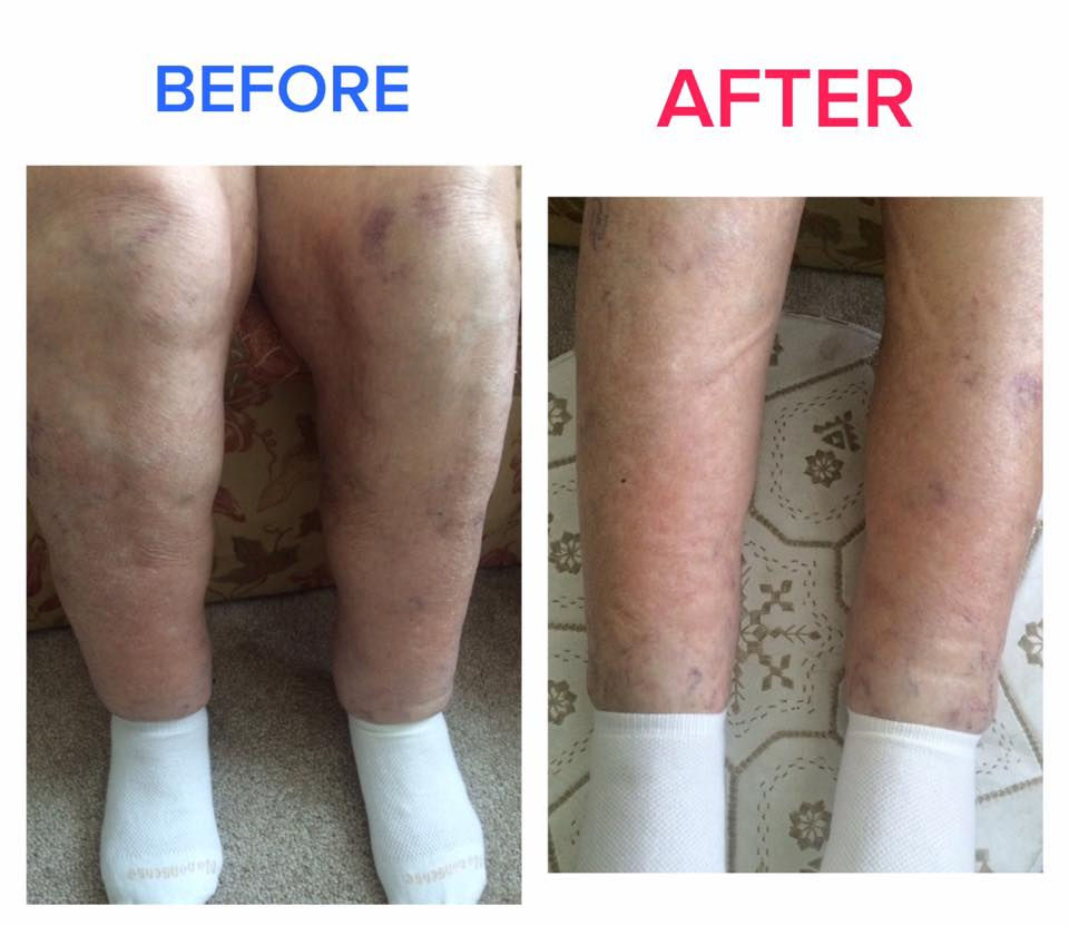 Before-and-after pneumatic compression therapy showing reduced swelling and improved leg appearance in a patient with chronic lymphedema. Consistent at-home treatment may help support circulation, improve comfort, and reduce fluid buildup over time.