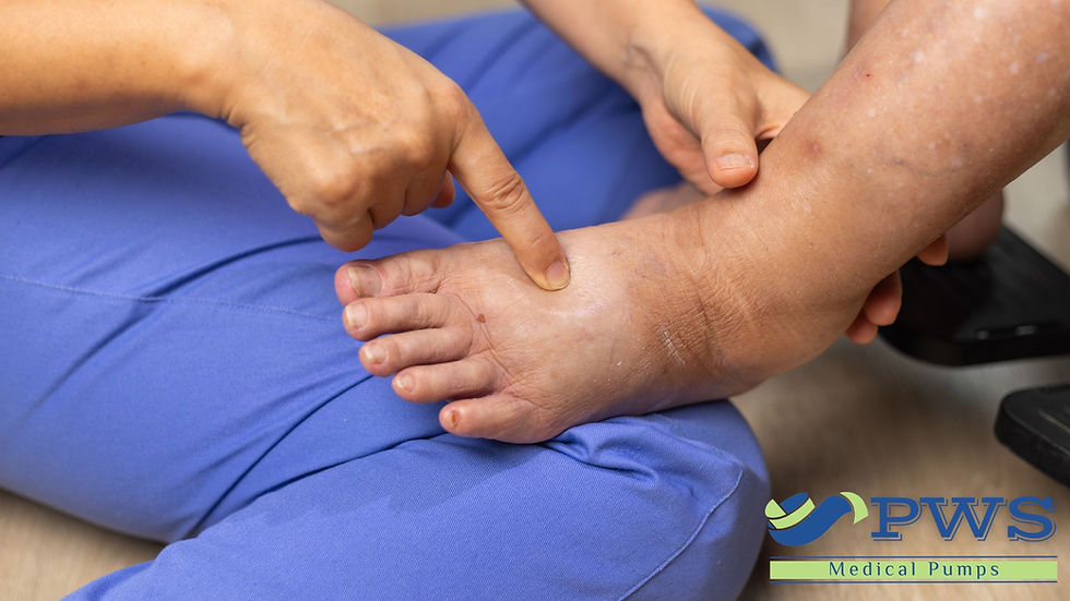 Healthcare professional assessing swelling in a patient's foot and ankle affected by lymphedema. The clinician is examining tissue changes and fluid accumulation as part of a lymphedema evaluation.