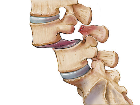 椎弓解離與脊椎滑脫的治療性運動