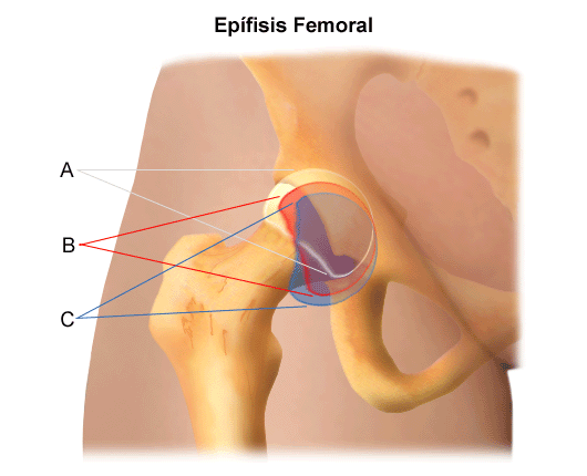 Deslizamiento_de_la_epÃfisis_capital_fem