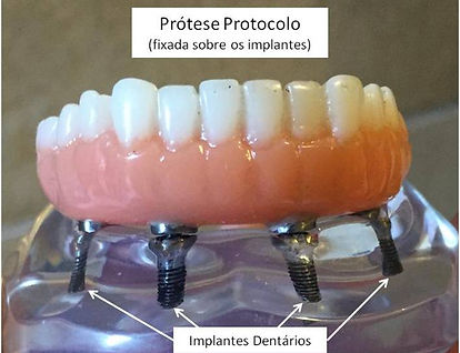 Protese Protocolo em Osasco - Protese Parafusada em Osasco - Dentadura Parafusada em Osasco - Sobredentadura em Osasco - Dentadura Fixa em Osasco - Protese sobre Implantes em Osasco - Dentadura Protocolo em Osasco - Dentadura sobre Implantes em Osasco - Overdenture em Osasco - Protese Protocolo Osasco - Protese Parafusada Osasco - Dentadura Parafusada Osasco - Sobredentadura Osasco - Dentadura Fixa Osasco - Protese sobre Implantes Osasco - Dentadura Protocolo Osasco - Dentadura sobre Implantes Osasco - Overdenture Osasco - Protese Protocolo Osasco Preco - Protese Parafusada Osasco Preco - Dentadura Parafusada Osasco Preco - Sobredentadura Osasco Preco - Protese sobre Implantes Osasco Preco - Especialista Protese Parafusada - Especialista Protese Protocolo - Especialista Overdenture