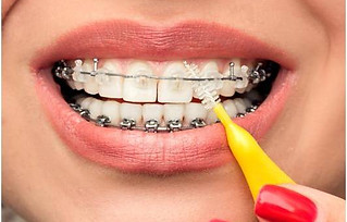 Aparelho Dente Osasco - Ortodontia em Osasco - Aparelho Ortodontico em Osasco - Aparelho Dental em Osasco - Aparelho Dentario em Osasco - Ortodontista em Osasco - Aparelho Fixo em Osasco - Tratamento Ortodontico em Osasco - Ortodontia Osasco - Aparelho Ortodontico Osasco - Aparelho Dental Osasco - Aparelho Dentario Osasco - Ortodontista Osasco - Aparelho Fixo Osasco - Tratamento Ortodontico Osasco - Clinica Ortodontia em Osasco - Clinica Ortodontia Osasco - Dentista Ortodontia Osasco - Dentista Orto Osasco - Colocar Aparelho Ortodontico Osasco - Colocar Aparelho Dental Osasco - Colocar Aparelho Dentario Osasco - Aparelho Ortodontico Osasco Preco - Aparelho Dental Osasco Preco - Aparelho Dentario Osasco Preco - Aparelho Ortodontico Osasco custo - Aparelho Dental Osasco custo - Ortodontia Osasco Preco - Ortodontista Osasco Preco - Tratamento Ortodontico Osasco Preco - Ortodontia Osasco custo - Ortodontista Osasco custo - Tratamento Ortodontico Osasco custo