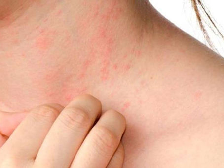 Reações a anti-inflamatórios: um diagnóstico comum que ainda passa despercebido