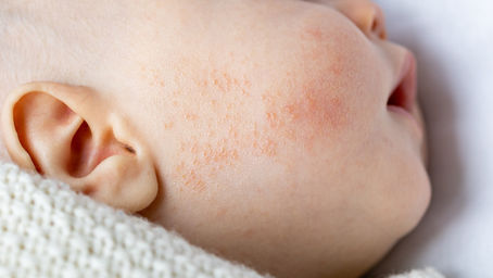 Cuidados com a pele do bebê com maior risco de dermatite atópica