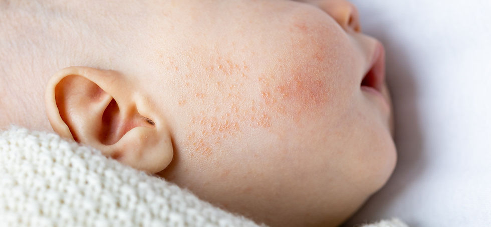 Cuidados com a pele do bebê com maior risco de dermatite atópica