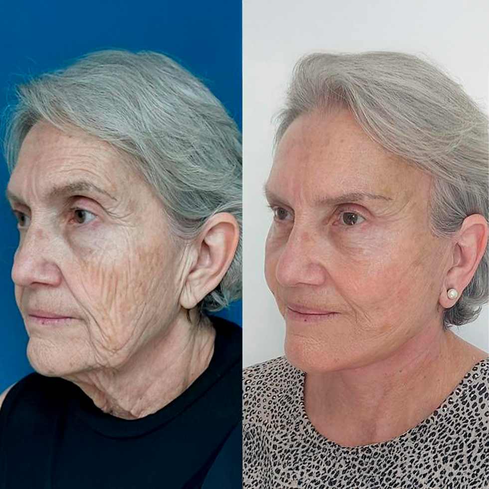 antes e depois 2.png