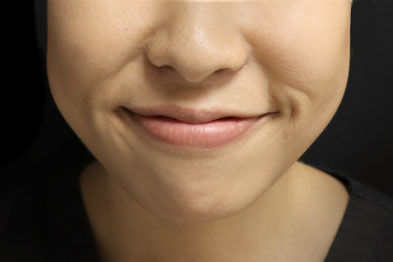 Jaw area after Botox