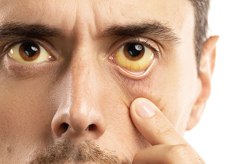 yellow fever jaundice