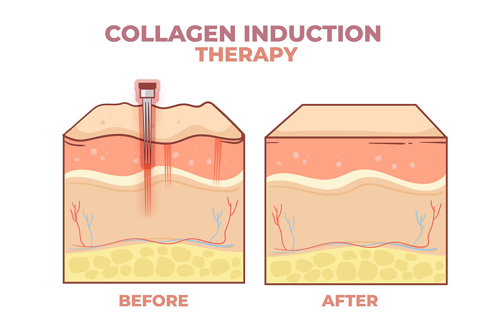 Cross-section of skin showing "Collagen Induction Therapy." Left: needles penetrating skin labeled "Before." Right: smooth skin labeled "After."