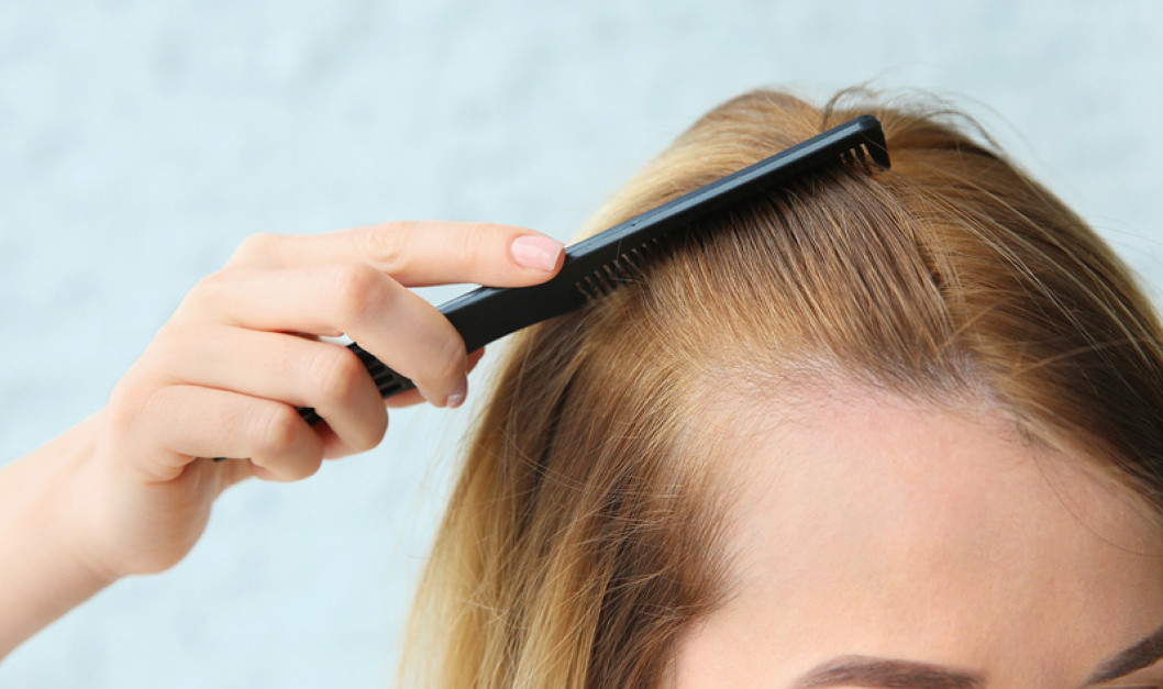 woman with hair loss, receding hairline