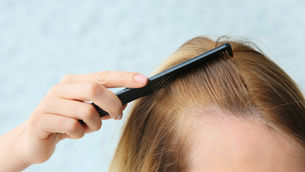woman with hair loss, receding hairline