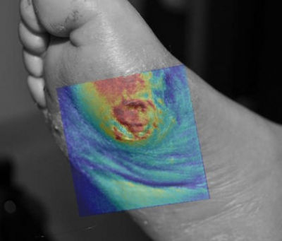 What Role Hyperspectral Imaging in the Wound Care and Hyperbaric Medicine Center?