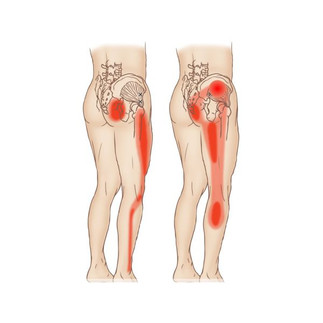 Neuropatija, Neuropatski Bol, Neuropatski bol i trnjenje u niz nogu doiza kolena i do stopala