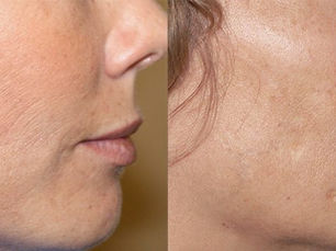 Why Choose Microneedling with Secret RF?