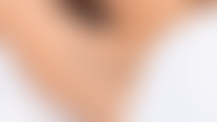 What’s New in Treating Hyperhidrosis (Excessive Sweating)?? by Dr. Stephanie Cotell