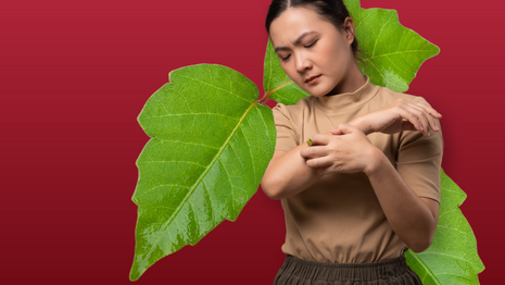 Treatment of Poison Ivy, Oak, and Sumac