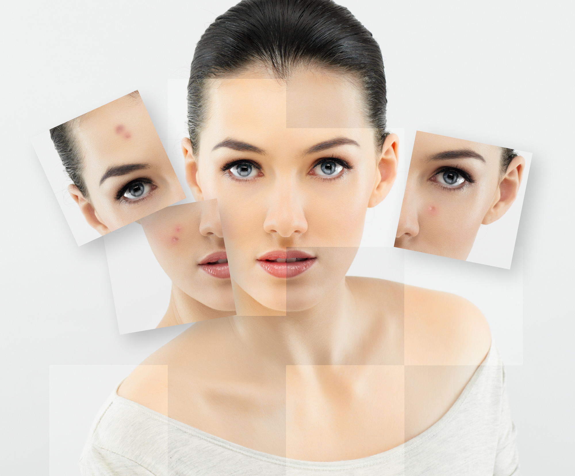 Acne Advanced $ 80.00