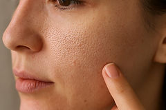 What Causes Enlarged Pores on Cheeks & How to Actually Minimize Them