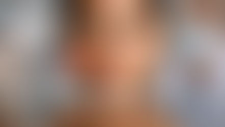 Hyperpigmentation Laser Treatment in Singapore