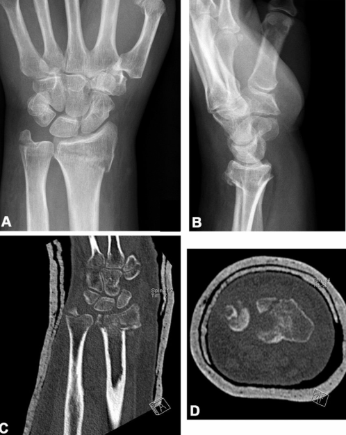 Four medical images showing X-rays and CT scans of a human wrist from various angles, highlighting bone structures.