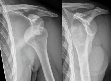 Best Treatment Options for Shoulder Dislocation By Dr. Kashyap Solanki