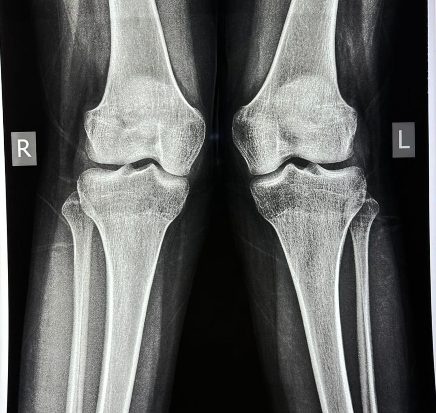 Understanding Distal Femoral Osteotomy(DFO) and Its Benefits for Knee Pain Relief