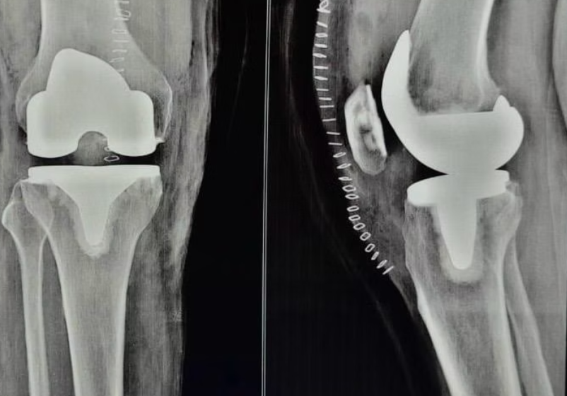 X-ray image of a knee with a metal implant, showing a full prosthetic joint replacement. Bones and implant are clearly visible.