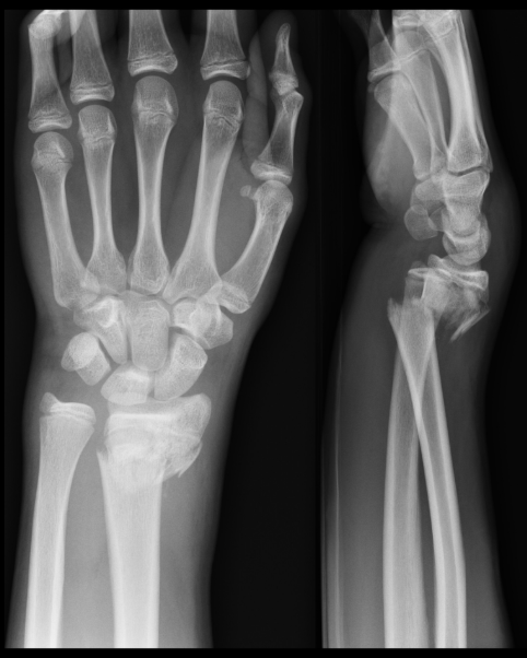 X-ray of a human wrist and hand, showing bones clearly. Two angles: top-down and side view. Black and white image.