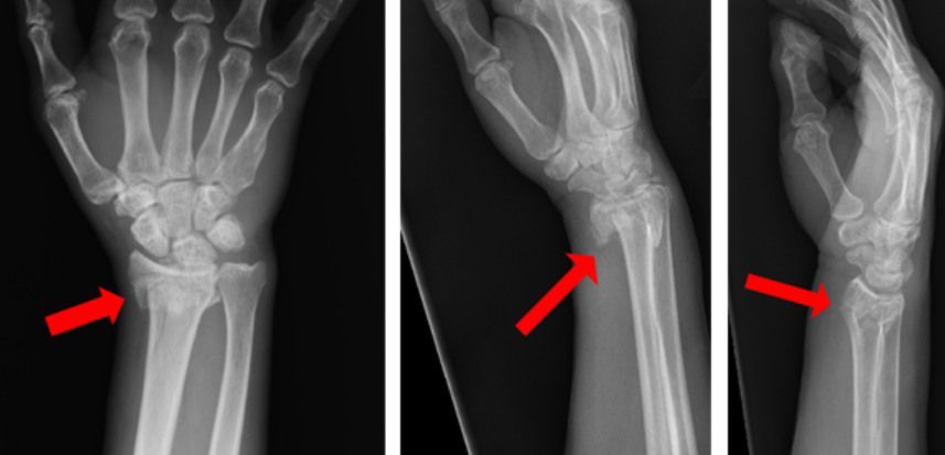 Effective Wrist Fracture Treatment Options for a Successful Recovery in Mumbai by Dr Kashyap Solanki