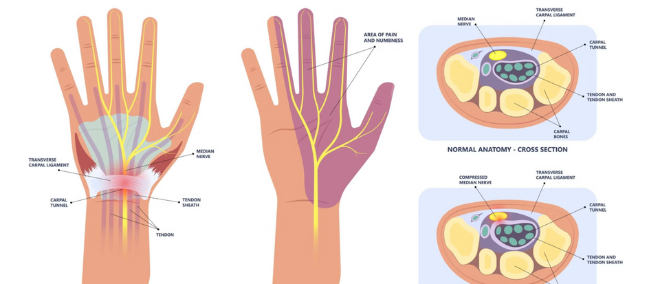 wrist affected by Carpal Tunnel Syndrome