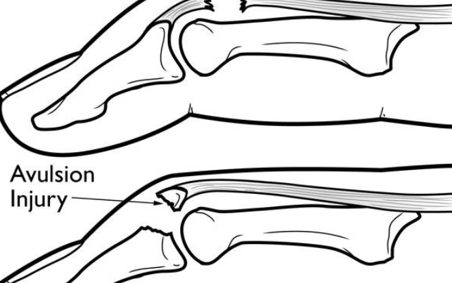 Understanding Mallet Finger Treatment and Recovery Options in Mumbai by Dr. Kashyap Prabhu Solanki