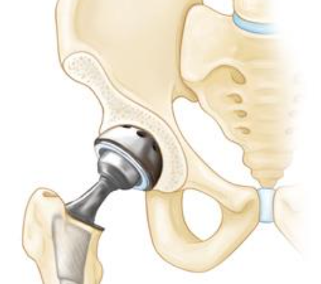 Breaking Down Myths About Hip Replacement Surgery - Dr Kashyap Solanki, Mumbai