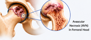 Understanding Core Decompression for Avascular Necrosis of the Hip: Benefits Risks and Success Stories in Mumbai by Dr. Kashyap Prabhu Solanki