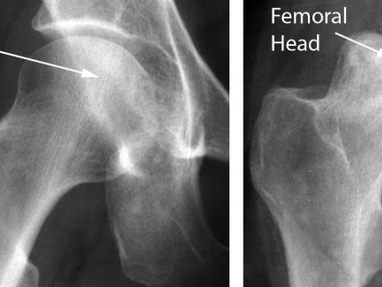 What Causes Osteonecrosis and How to Prevent It By Dr. Kashyap Solanki – Orthopaedic Surgeon, Andheri East, Mumbai