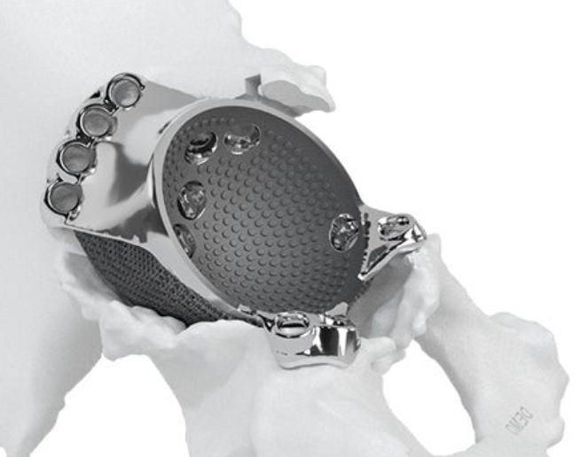 Metallic hip implant with a textured surface is set in a 3D-printed pelvic bone model. The background is plain white.