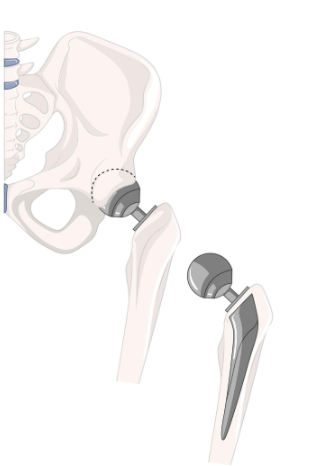 Recovery Timeline for Hip vs. Knee vs. Replacement: What’s the Difference?