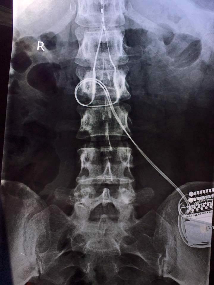 Burning to Live with Complex Regional Pain Syndrome