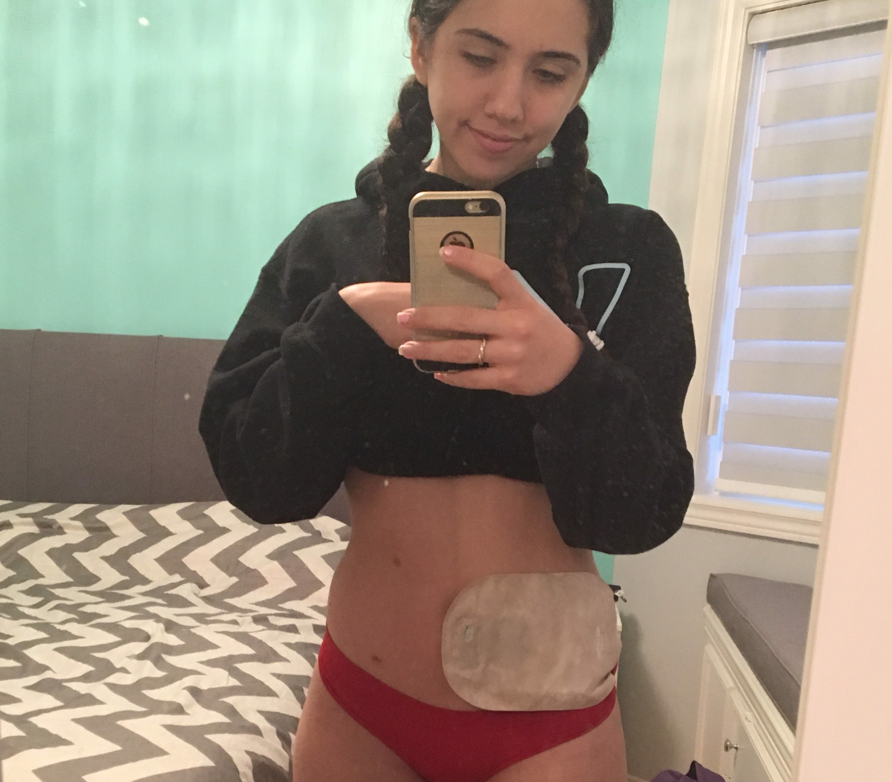 My Journey with Ulcerative Colitis