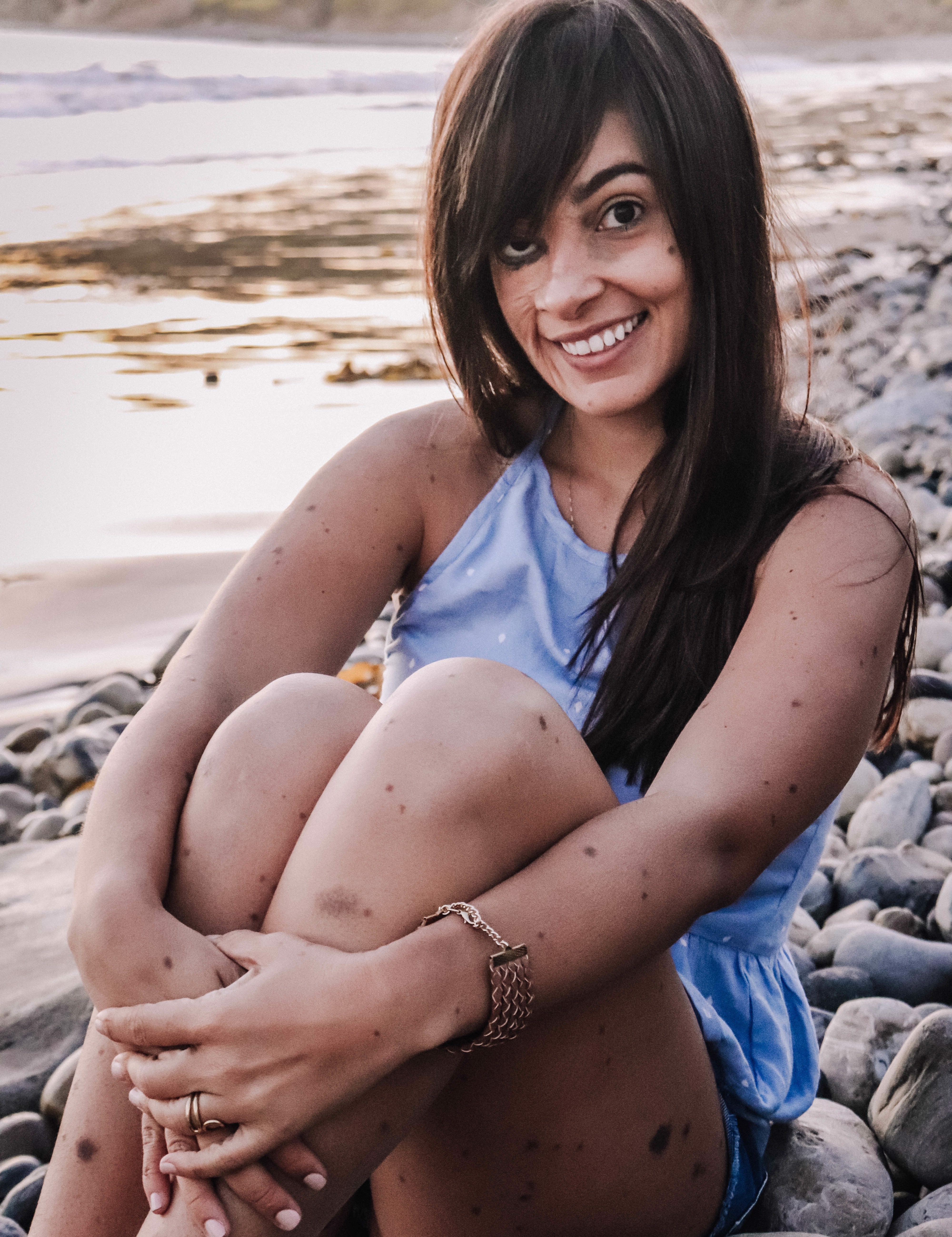 What happened to my face: Loving my dots with Nevus