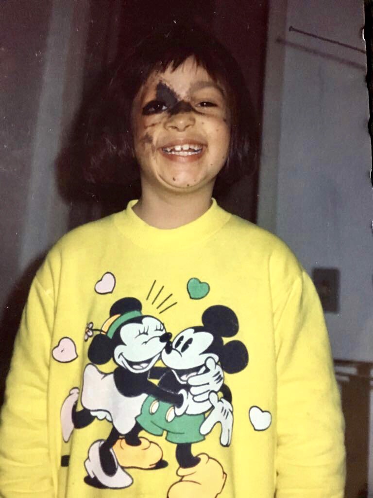 What happened to my face: Loving my dots with Nevus