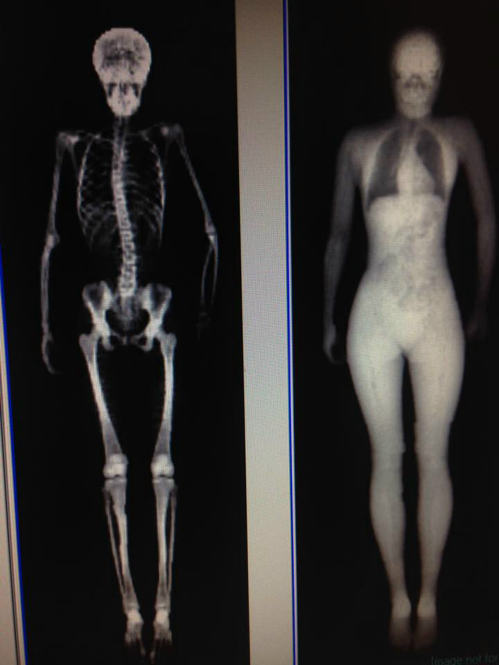 I Fight Osteogenesis Imperfecta & Traumatic Brain Injury