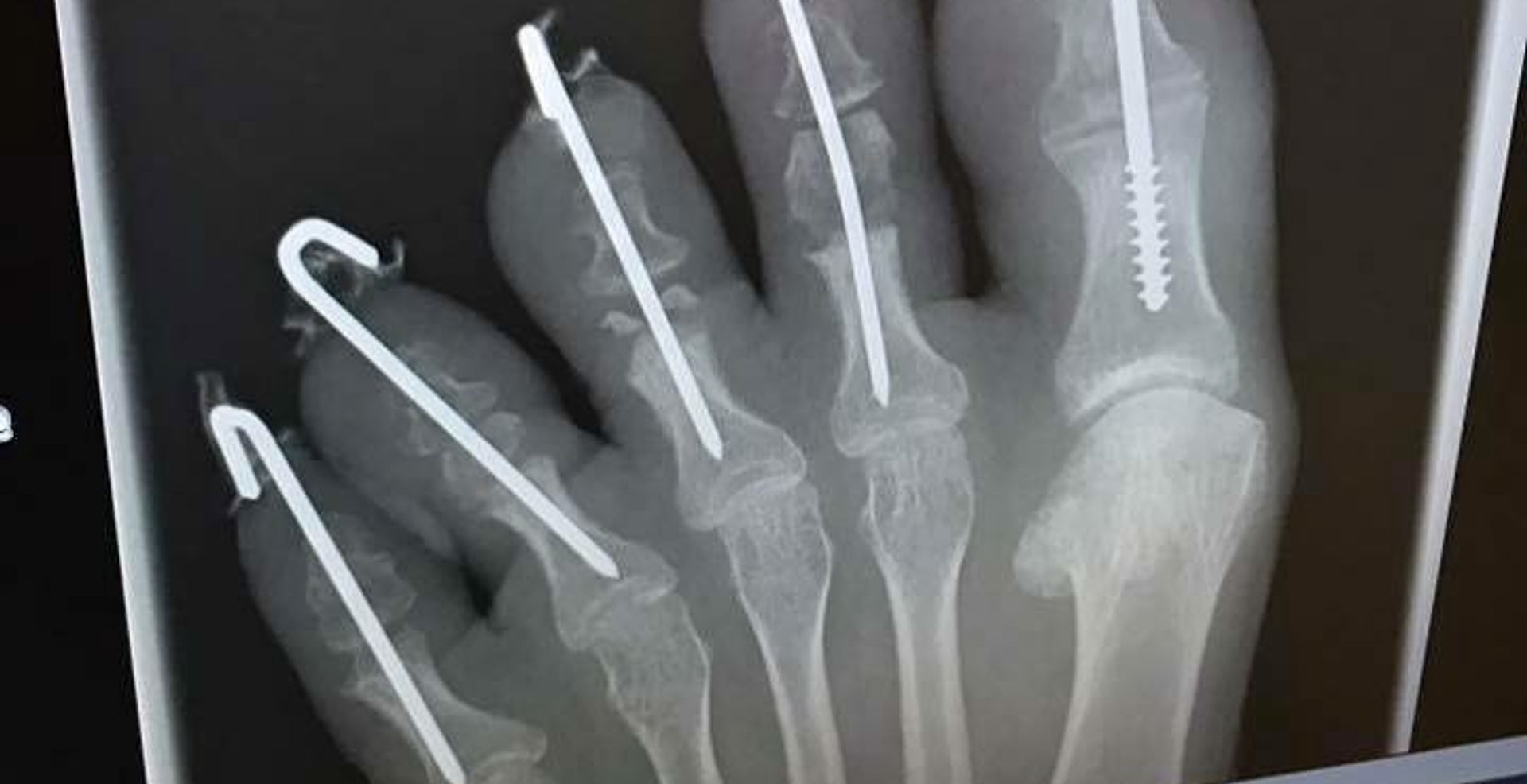 My Cerebral Palsy Story & How I Became Bionic Becky