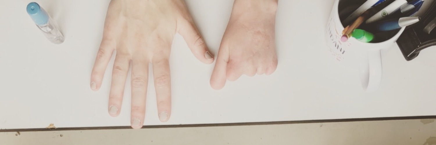 Navigating Life with a Limb Difference