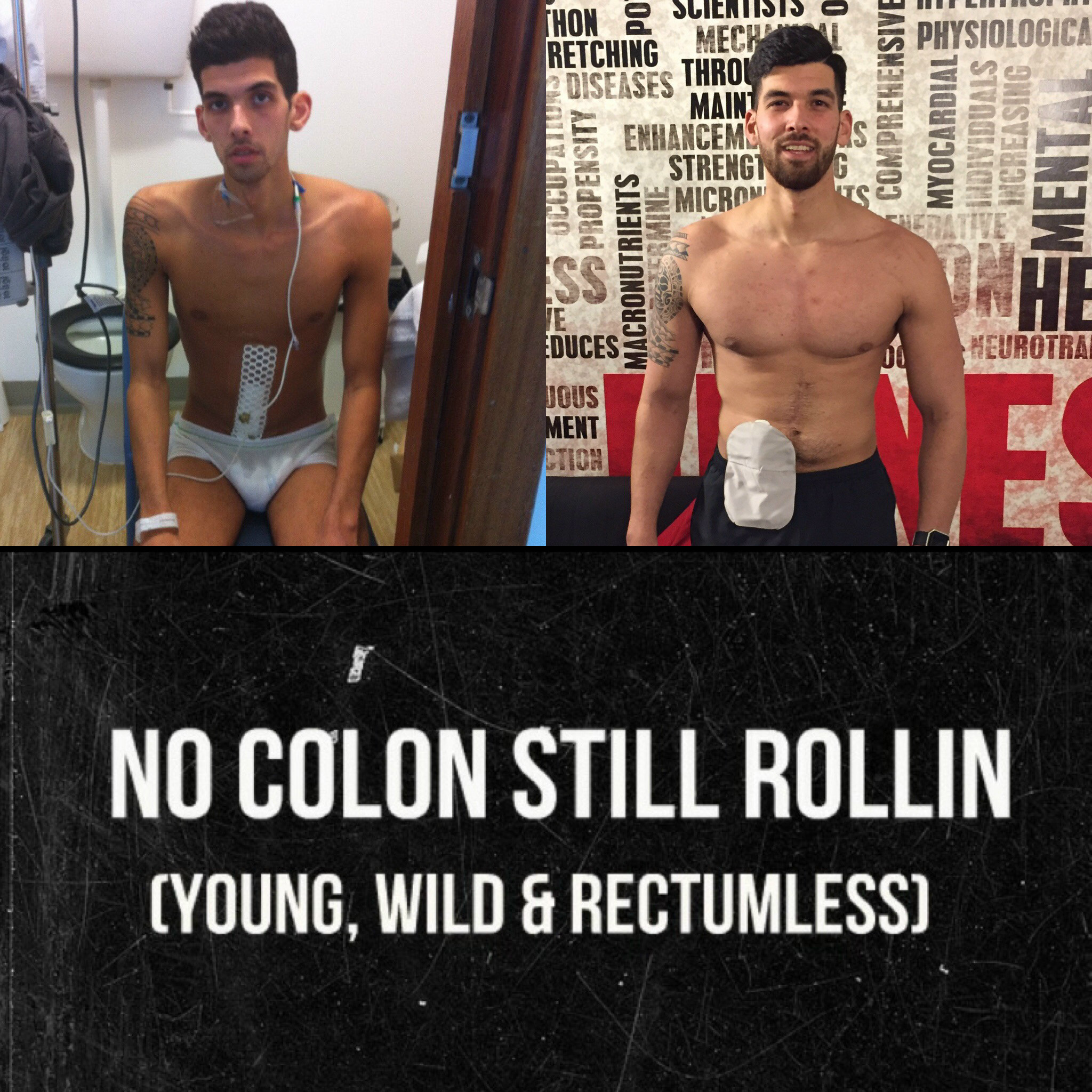Ulcerative Colitis: #NoColonStillRollin
