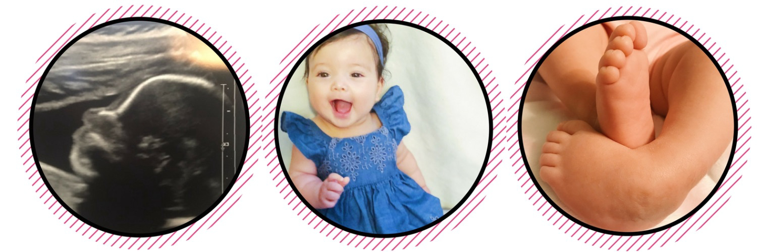 Rally4Riley: Our Spina Bifida Warrior